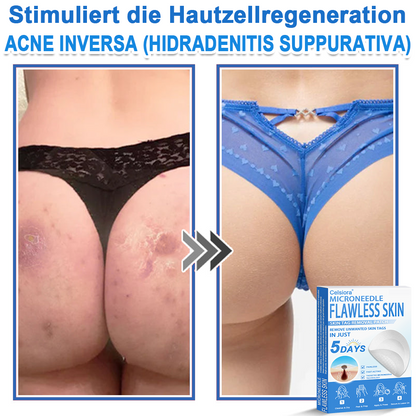 👩‍⚕️ Celsiora® 2-in-1 Mikronadel- & Hydrokolloid-Pflaster | Entferner für erhabene Muttermale, Akne, flache Warzen & Hautanhängsel | Verbessert Falten, Narben & Hautunreinheiten | Unsichtbare Stern-Pickelpflaster für Gesicht & Körper