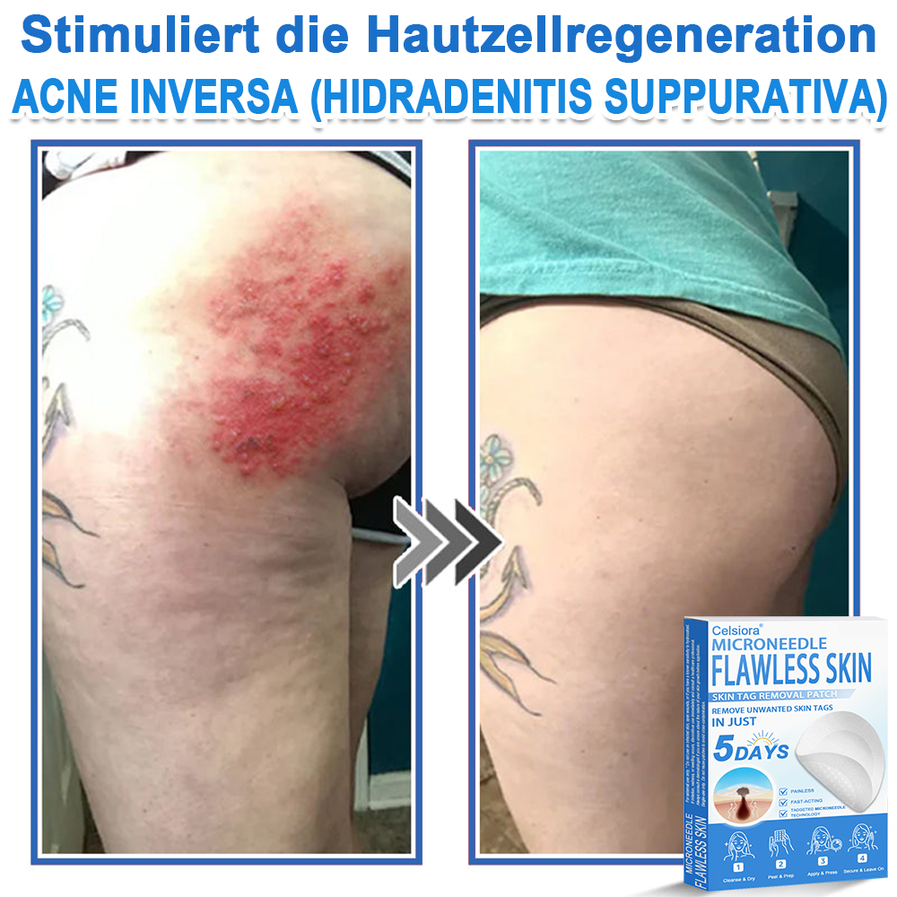 👩‍⚕️ Celsiora® 2-in-1 Mikronadel- & Hydrokolloid-Pflaster | Entferner für erhabene Muttermale, Akne, flache Warzen & Hautanhängsel | Verbessert Falten, Narben & Hautunreinheiten | Unsichtbare Stern-Pickelpflaster für Gesicht & Körper