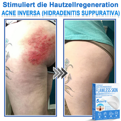 👩‍⚕️ Celsiora® 2-in-1 Mikronadel- & Hydrokolloid-Pflaster | Entferner für erhabene Muttermale, Akne, flache Warzen & Hautanhängsel | Verbessert Falten, Narben & Hautunreinheiten | Unsichtbare Stern-Pickelpflaster für Gesicht & Körper