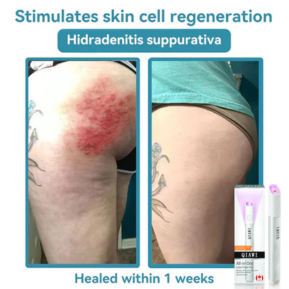 ✨QIAWI All-in-One CO₂ Laser Eraser Pen | Removes Moles, Warts, Skin Flaws & Pigmentation