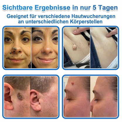 👩‍⚕️ Celsiora® 2-in-1 Mikronadel- & Hydrokolloid-Pflaster | Entferner für erhabene Muttermale, Akne, flache Warzen & Hautanhängsel | Verbessert Falten, Narben & Hautunreinheiten | Unsichtbare Stern-Pickelpflaster für Gesicht & Körper