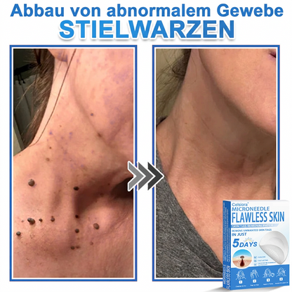 👩‍⚕️ Celsiora® 2-in-1 Mikronadel- & Hydrokolloid-Pflaster | Entferner für erhabene Muttermale, Akne, flache Warzen & Hautanhängsel | Verbessert Falten, Narben & Hautunreinheiten | Unsichtbare Stern-Pickelpflaster für Gesicht & Körper