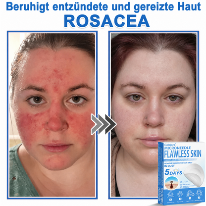 👩‍⚕️ Celsiora® 2-in-1 Mikronadel- & Hydrokolloid-Pflaster | Entferner für erhabene Muttermale, Akne, flache Warzen & Hautanhängsel | Verbessert Falten, Narben & Hautunreinheiten | Unsichtbare Stern-Pickelpflaster für Gesicht & Körper